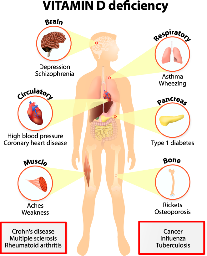 vitamin-d-deficiency-signs-symptoms-fixes_1.png